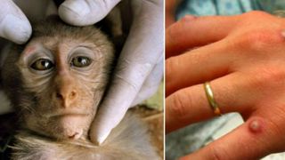 Suedia confirmă primul caz de variola maimuței