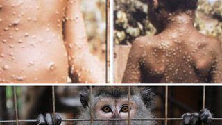 Prima suspiciune de variolă în România, după 45 de ani