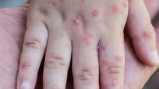 Ce simptome are variola maimuței și cum se transmite acest virus