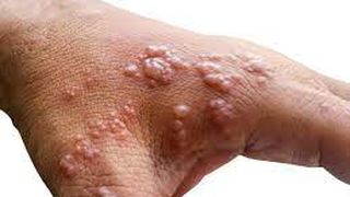 Tot ce trebuie să știi despre variola maimuței. Care este tratamentul în cazul infectării?