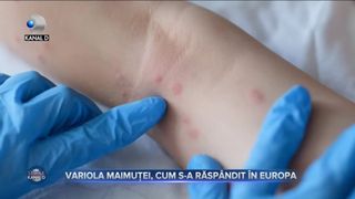 Variola maimuței, cum s-a răspândit în Europa