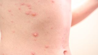 „Virusul poate să se transmită de pe haine”. Doctorul Marius Geantă, anunț despre variola maimuței