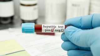 Marea Britanie: Alte 20 de cazuri de hepatită de origine necunoscută la copii