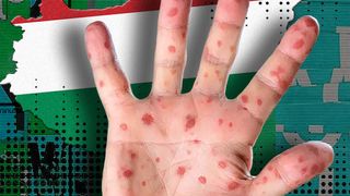 VIDEO - Primul caz de variola maimuței înregistrat la granița României