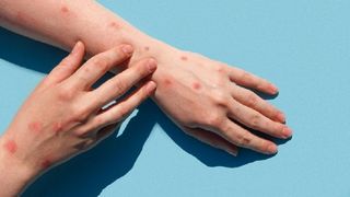 Anunț OMS: Epidemiile de boli endemice precum variola maimuţelor devin tot mai frecvente