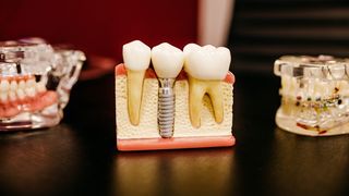 Care sunt avantajele implanturilor dentare și c&acirc;nd ai nevoie de ele