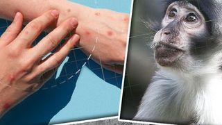 VIDEO - Al doilea caz de variola maimuței a fost depistat în România