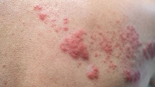 Ce simptome are zona zoster, afecțiunea cu care a fost diagnosticat Jens Stoltenberg, secretarul general al NATO