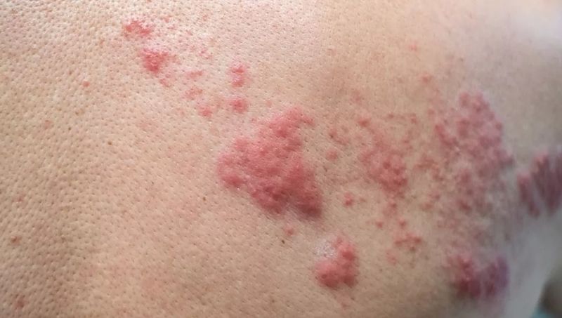 Ce simptome are zona zoster, afecțiunea cu care a fost diagnosticat Jens Stoltenberg, secretarul general al NATO