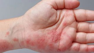 Ce simptome are zona zoster, afecțiunea cu care a fost diagnosticat Jens Stoltenberg, secretarul general al NATO