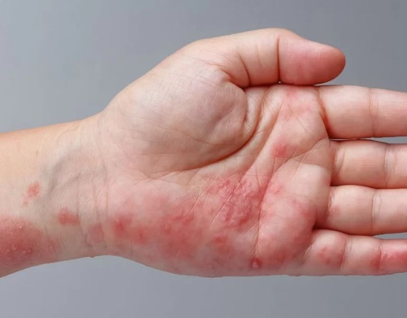 Ce simptome are zona zoster, afecțiunea cu care a fost diagnosticat Jens Stoltenberg, secretarul general al NATO