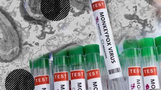 Al cincilea caz de variola maimuței a fost diagnosticat în România