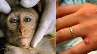  14.000 de cazuri de variola maimuței la nivel global și cinci decese raportate