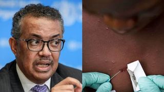 Organizaţia Mondială a Sănătăţii, anunț important despre variola maimuței