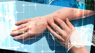 Alertă la nivel mondial de variola maimuței. Anunțul a fost făcut de Organizația Mondială a Sănătăţii