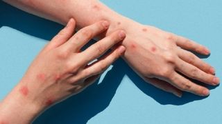 Directorul OMS solicită evitarea discriminării &icirc;n cazul pacienţilor cu variola maimuţei: "Stigmatizarea şi discriminarea pot fi la fel de periculoase ca orice virus&rdquo;