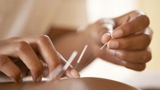 Cum ne ajută acupunctura să ne &icirc;ntărim sistemul imunitar?