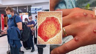 Cel mai mare număr de cazuri de variola maimuţei