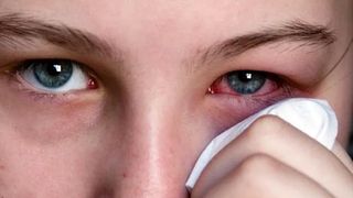 Simptome conjunctivită