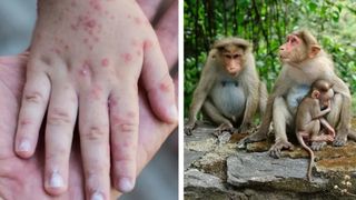 Un șofer care s-a întors din Germania, infectat cu variola maimuței