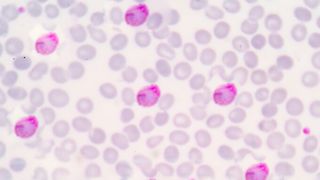  Un bărbat întors din Camerun este internat cu malarie