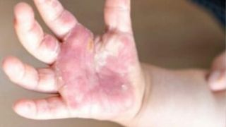 Gripa tomatelor. Care este primul simptom al noii boli