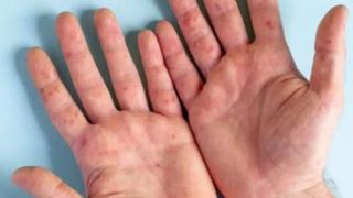 Gripa tomatelor. Care este primul simptom al noii boli