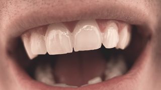 Ce &icirc;nseamnă dacă visezi că &icirc;ți cad dinții?