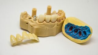 Ce durată de viață are un implant dentar și în ce constă intervenția de inserție?