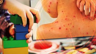 Mai multe focare de varicelă au fost descoperite &icirc;n școlile și grădinițile din Gorj