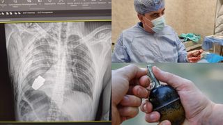 Un chirurg a reușit să îndepărteze o grenadă care putea exploda, din corpul unui soldat ucrainean
