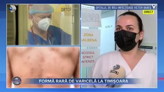 Formă rară de varicelă la Timișoara