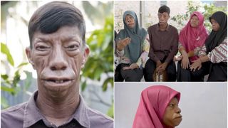 O familie unică. Cine sunt „frații reptilă” și de ce condiție medicală suferă. Vecinii lor cred că sunt blestemați