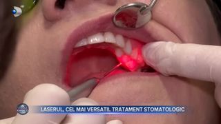 Laserul, cel mai versatil tratament stomatologic