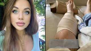 O femeie de 36 de ani, la un pas de amputarea unui picior după mai multe pahare de băutură