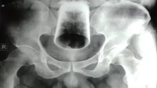 Un gest teribilist la băutură l-a dus la o vizită rușinoasă la spital