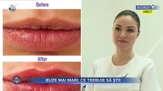 Buze mai mari- Ce trebuie să știi