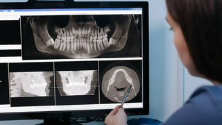 C&acirc;nd știi că &icirc;ți este necesară o adiție de os dentar? Cele PATRU situații &icirc;n care trebuie să apelezi la această intervenție chirurgicală
