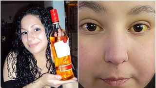 Femeia cu ochii galbeni de la alcool, de nerecunoscut după ce s-a lăsat de băutură