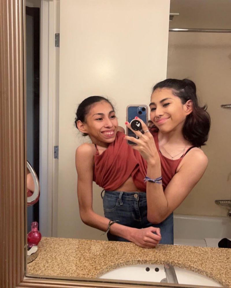 Surorile siameze Lupita și Carmen Andrade