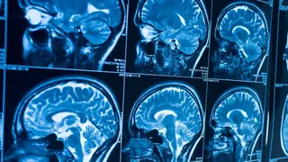 Se extinde o afecțiune misterioasă a creierului. Ce este sindromul mortal asemănător demenței care îi sperie pe tineri cu halucinații și pierderea memoriei