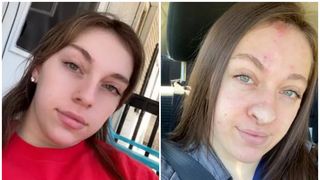 O tânără de 20 de ani s-a trezit că-i crește păr pe nas după o operație riscantă - FOTO