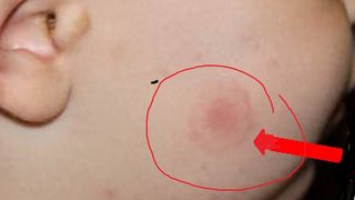 Boala Lyme poate fi recunoscută ușor &icirc;n primul stadiu iar eritemul apare &icirc;n c&acirc;teva zile.