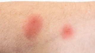 Ce să faci dacă te-a mușcat un paianjen? Este important să acționezi imediat