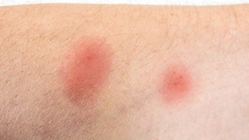 Ce să faci dacă te-a mușcat un paianjen? Este important să acționezi imediat