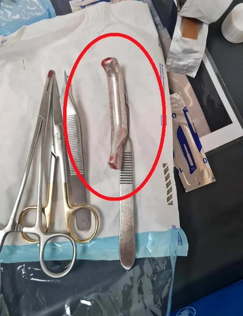 Un accident de bicicletă a ajuns un adevărat coșmar pentru un bărbat. Medicul care l-a operat i-a uitat în rană mânerul bicicletei. 3 săptămâni de chin