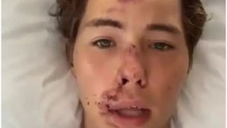 Un star de pe TikTok a ajuns să suporte chinuri &icirc;ngrozitoare după ce a căzut de pe o st&acirc;ncă de 80 de metri pe roci cu lavă &icirc;ncinsă