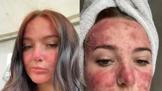 După ce a fost batjocorită toată viața din cauza acneei, această t&acirc;nără a devenit  o influenceriță de frumusețe. Avea toată fața plină de coșuri