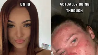 După ce a fost batjocorită toată viața din cauza acneei, această t&acirc;nără a devenit  o influenceriță de frumusețe. Avea toată fața plină de coșuri