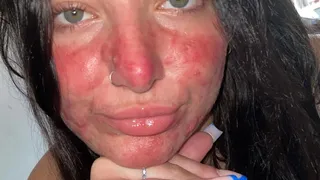 După ce a fost batjocorită toată viața din cauza acneei, această t&acirc;nără a devenit  o influenceriță de frumusețe. Avea toată fața plină de coșuri